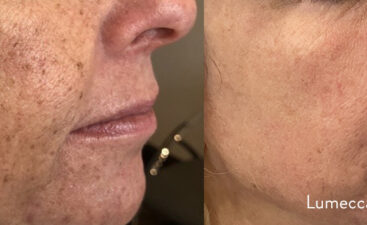 lumecca-before-after-dr-j-owen-preview-1